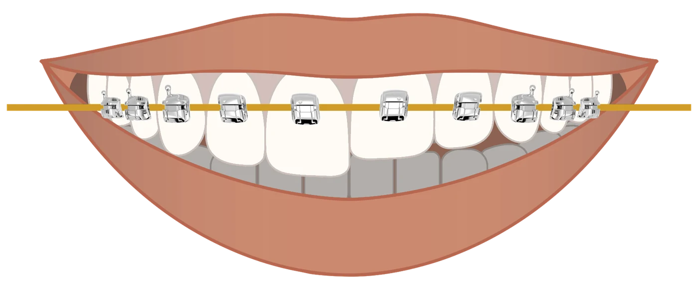 Illustration of Smile Arc Protection bracket placement: brackets on the upper front teeth sit closer to the gums, aligned along a straight guide line with the side teeth.