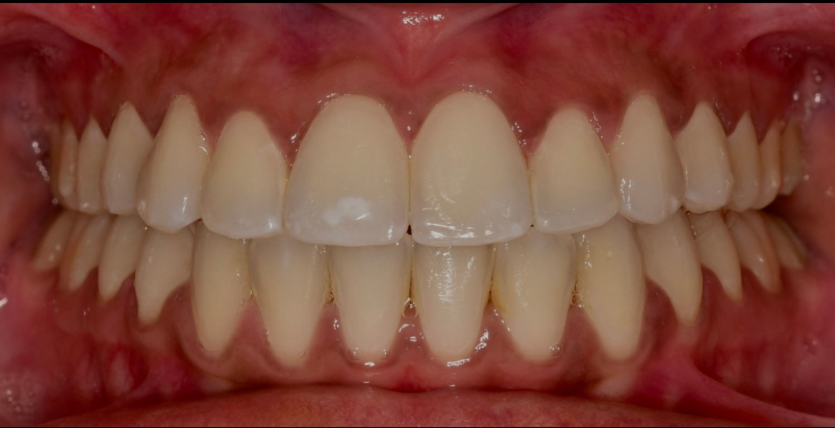 After braces — close-up