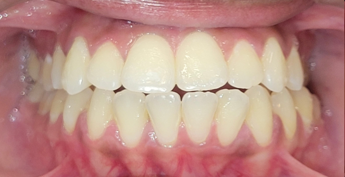 Before braces — close-up