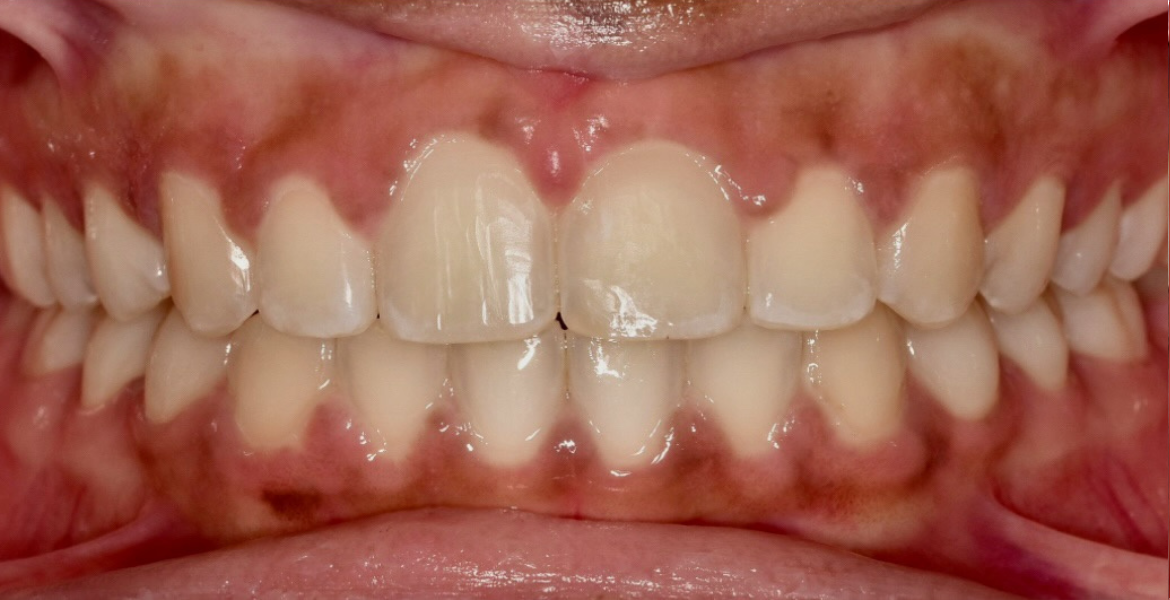 After braces — close-up