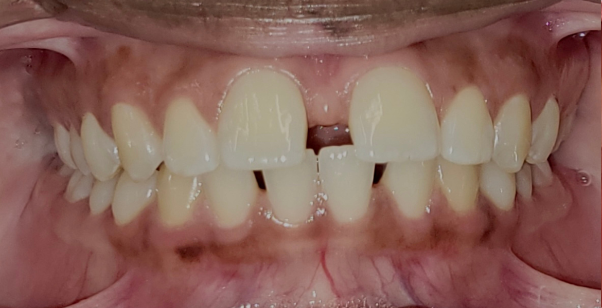 Before braces — close-up