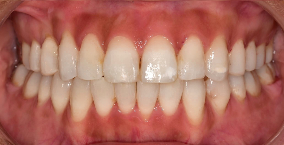 After braces — close-up