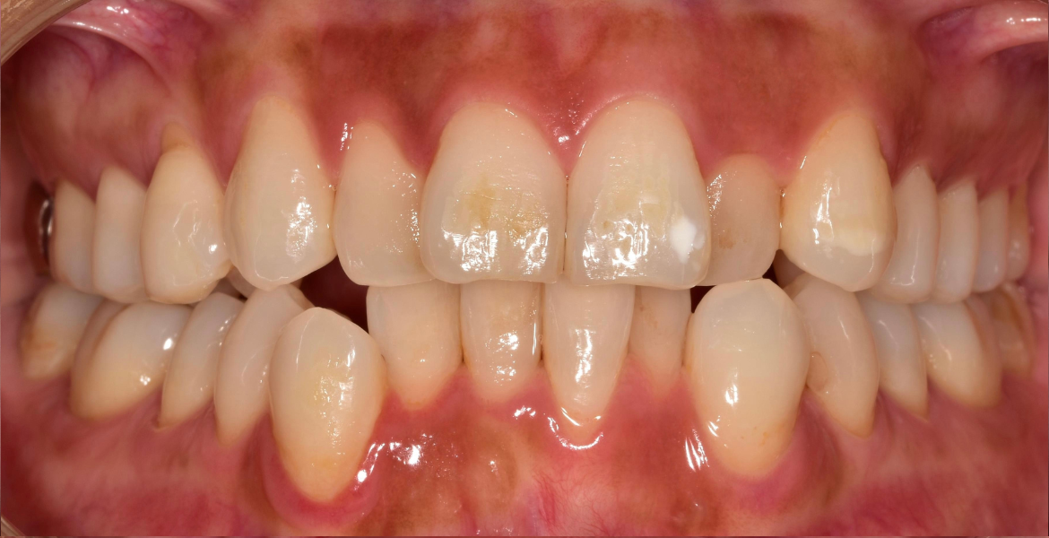 Before braces — close-up