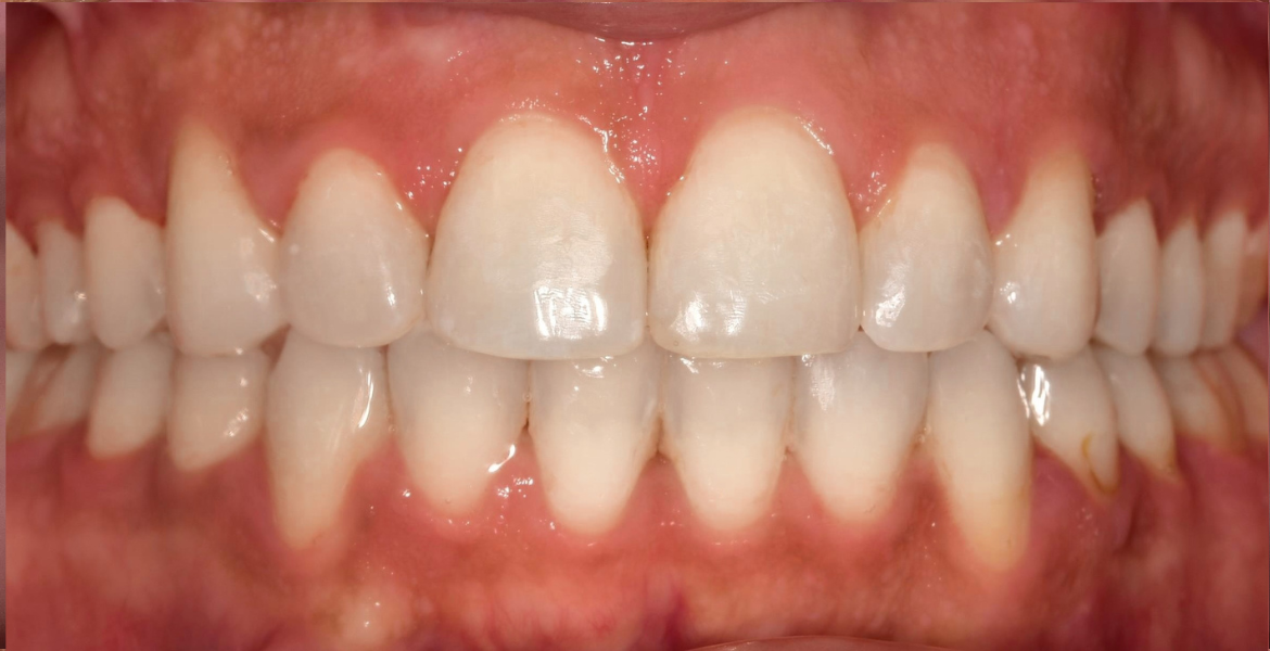 After braces — close-up