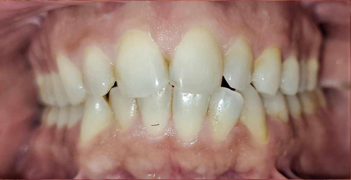 Before braces — close-up