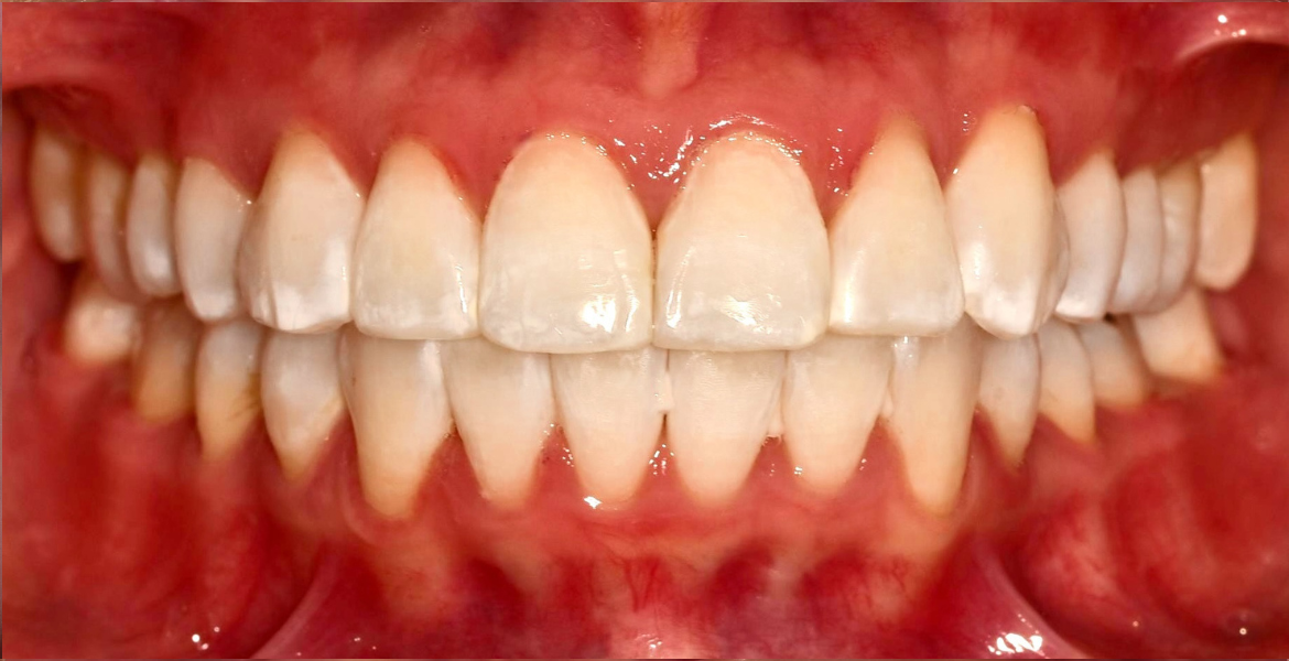 After braces — close-up