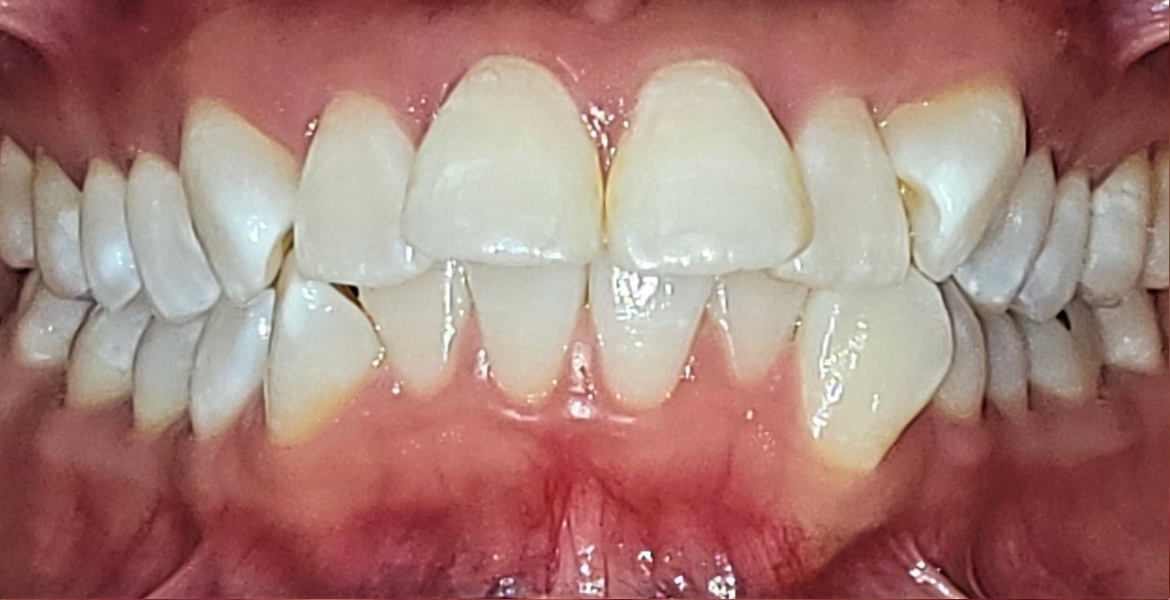 Before braces — close-up