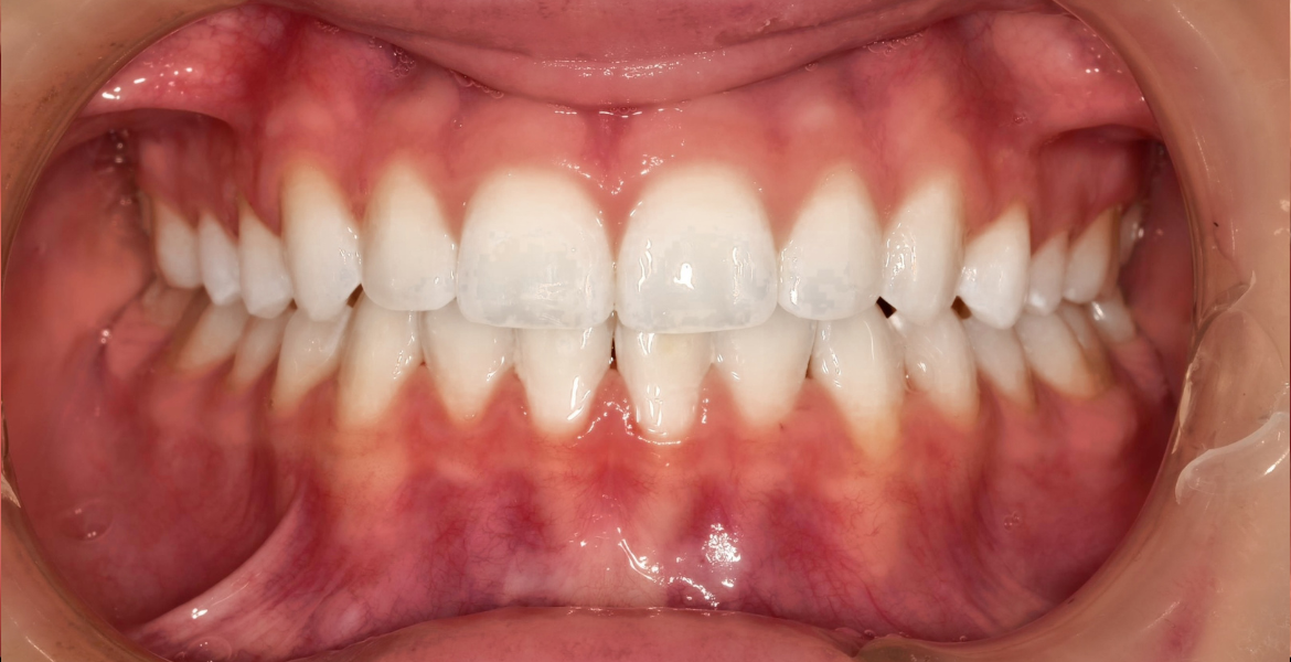 After clear aligners — close-up