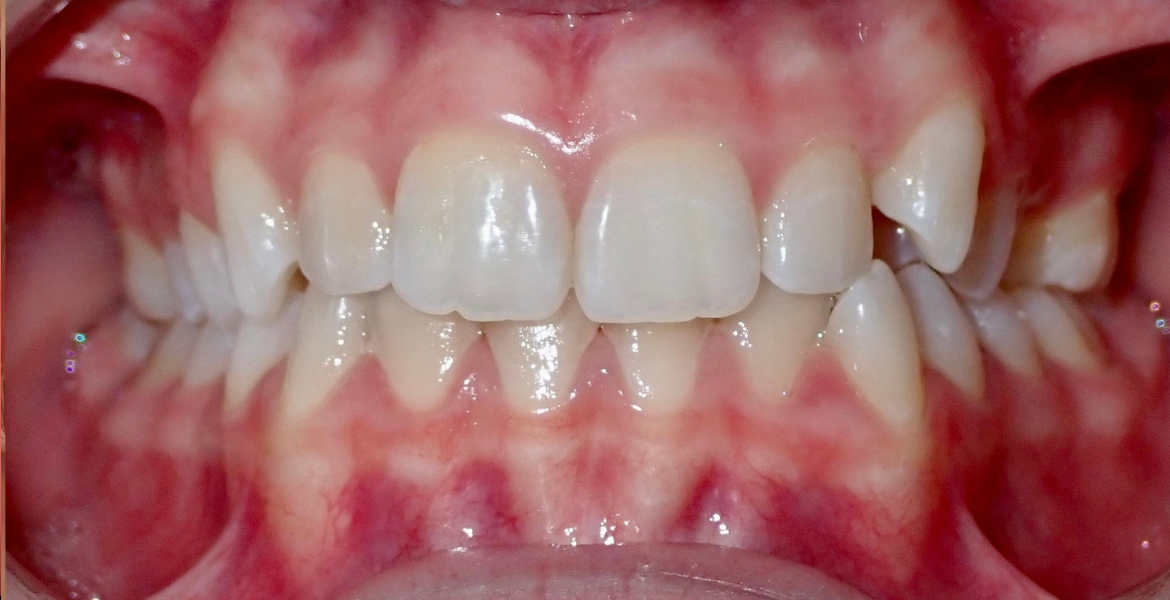 Before clear aligners — close-up