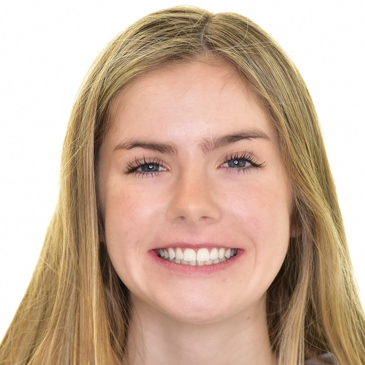 After clear aligners