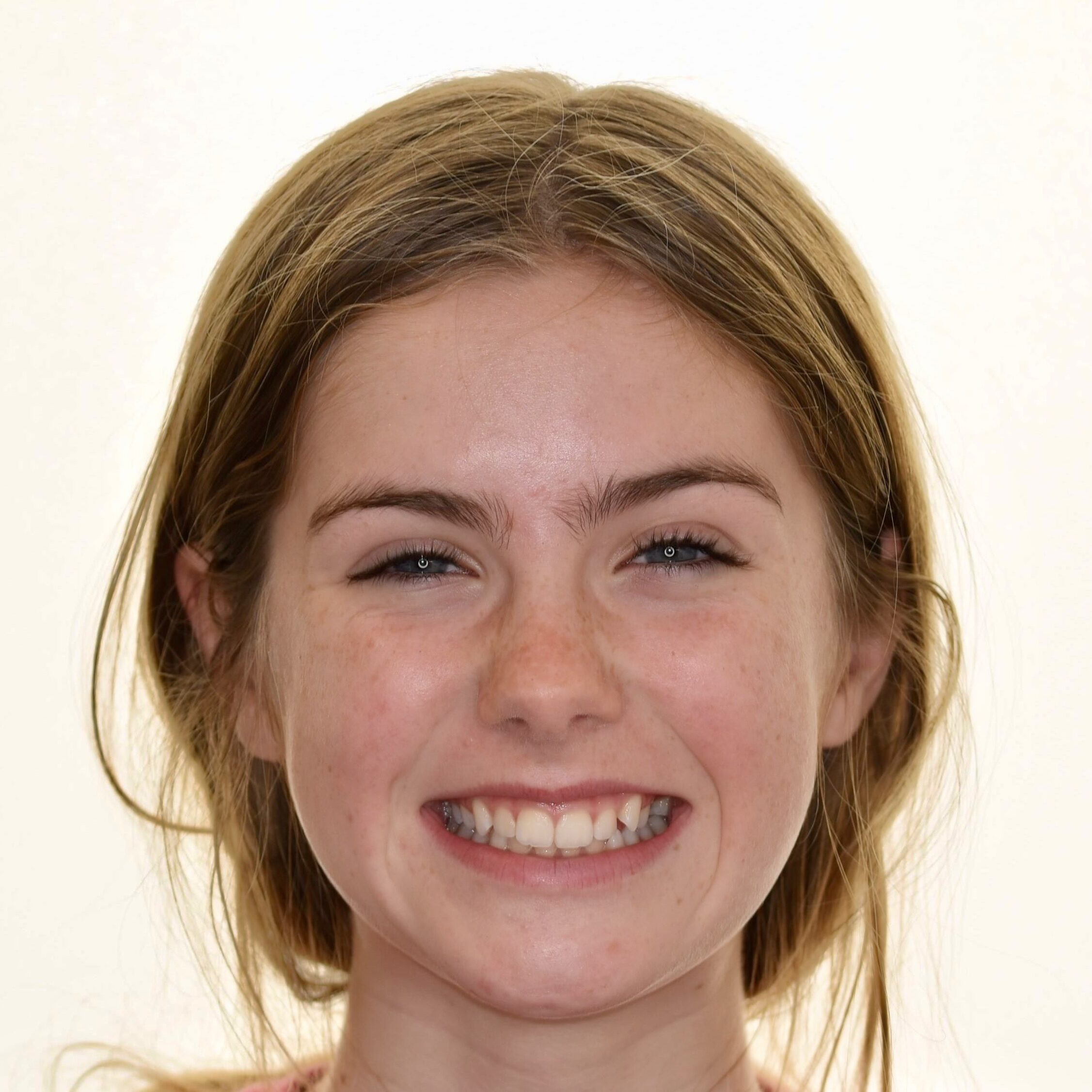 Before clear aligners