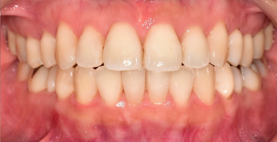 After lingual braces — close-up