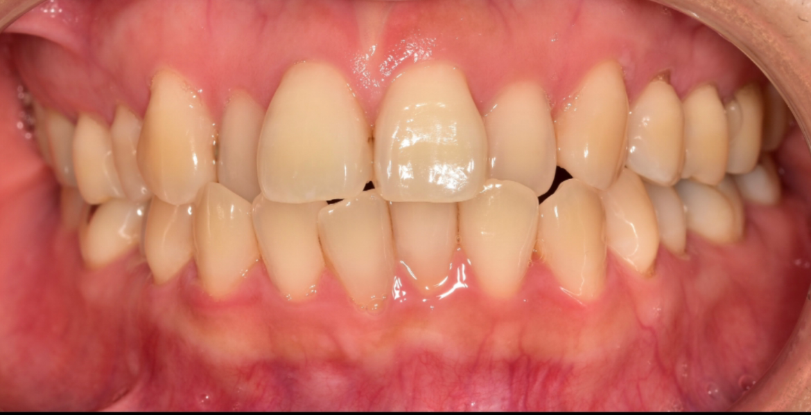 Before lingual braces — close-up