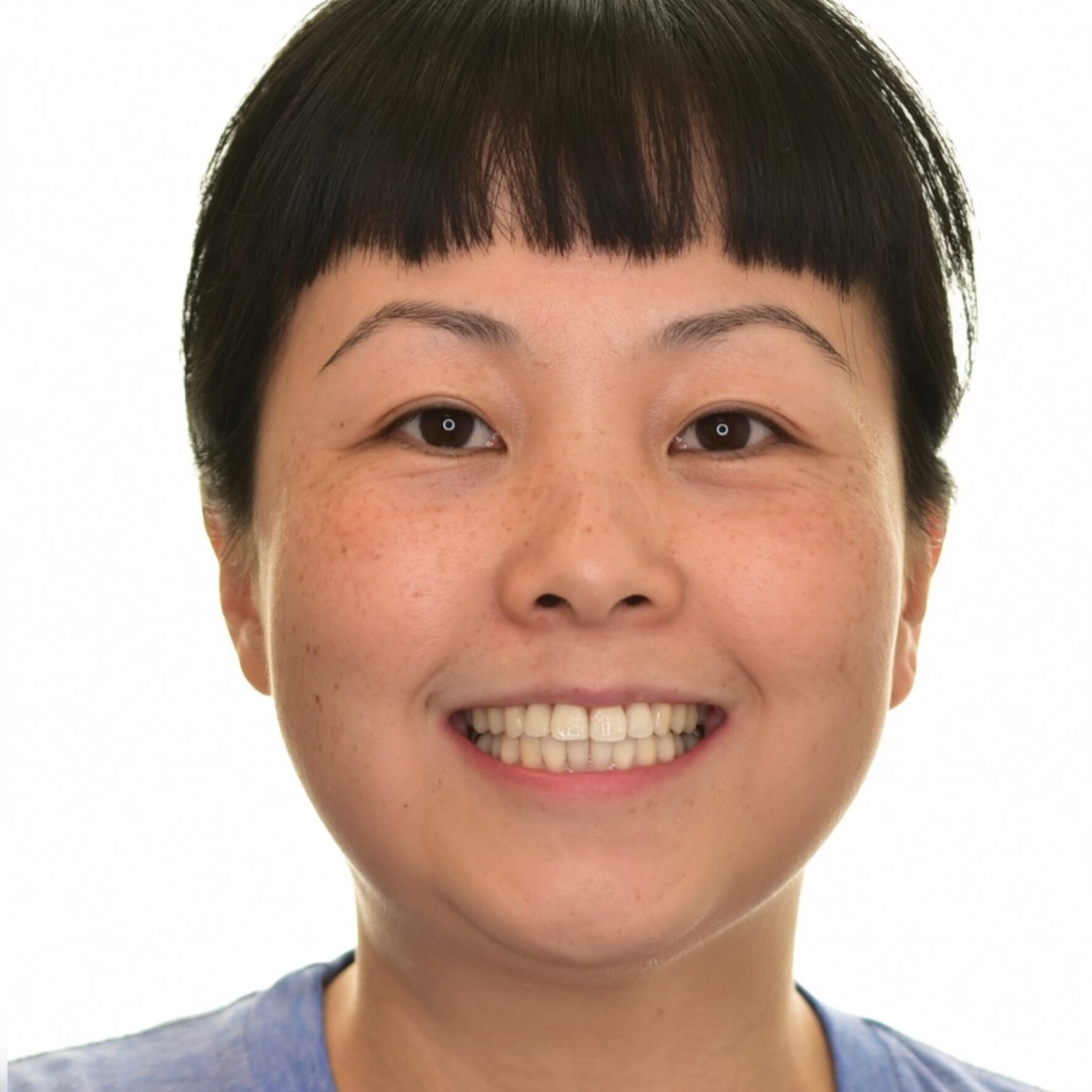 After lingual braces