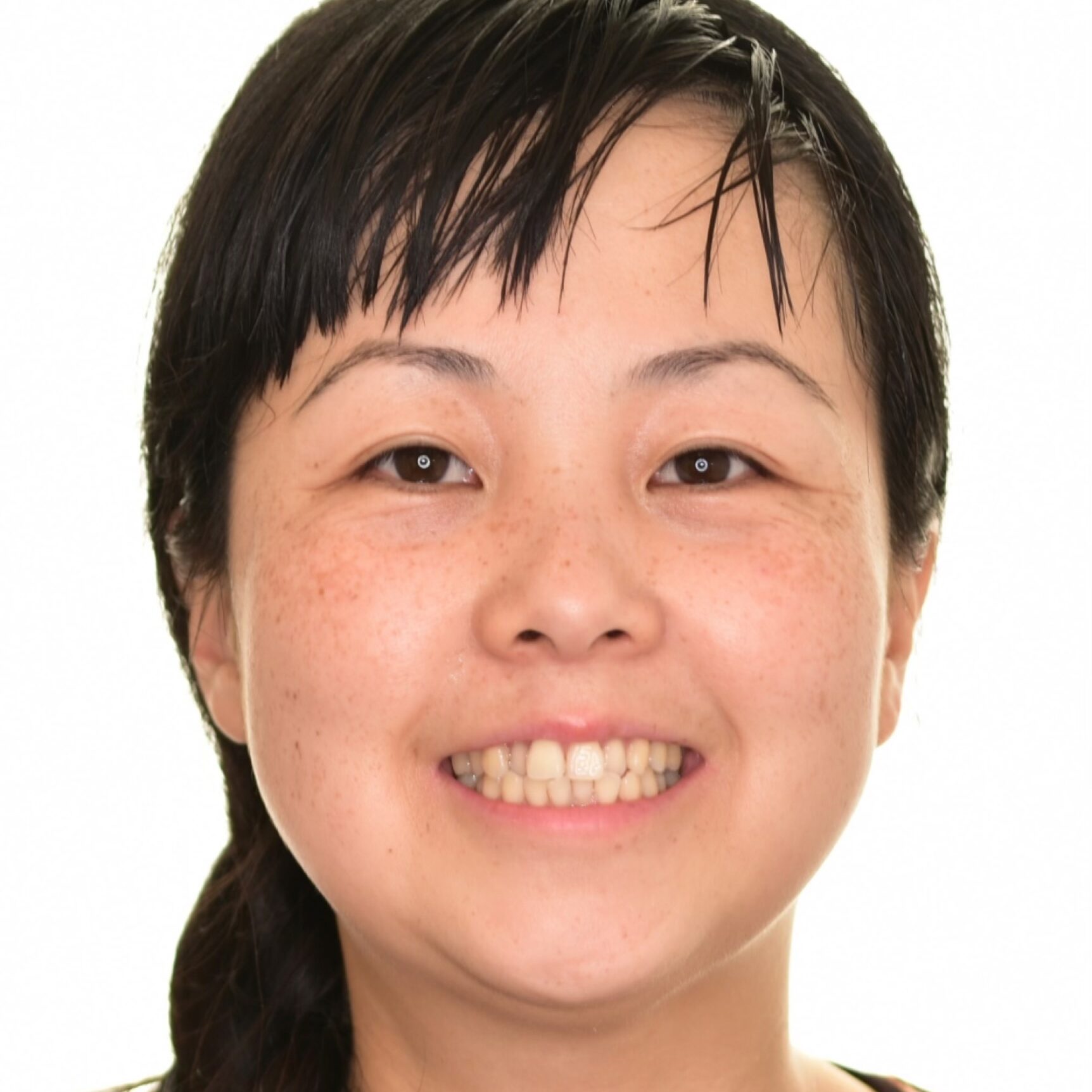 Before lingual braces