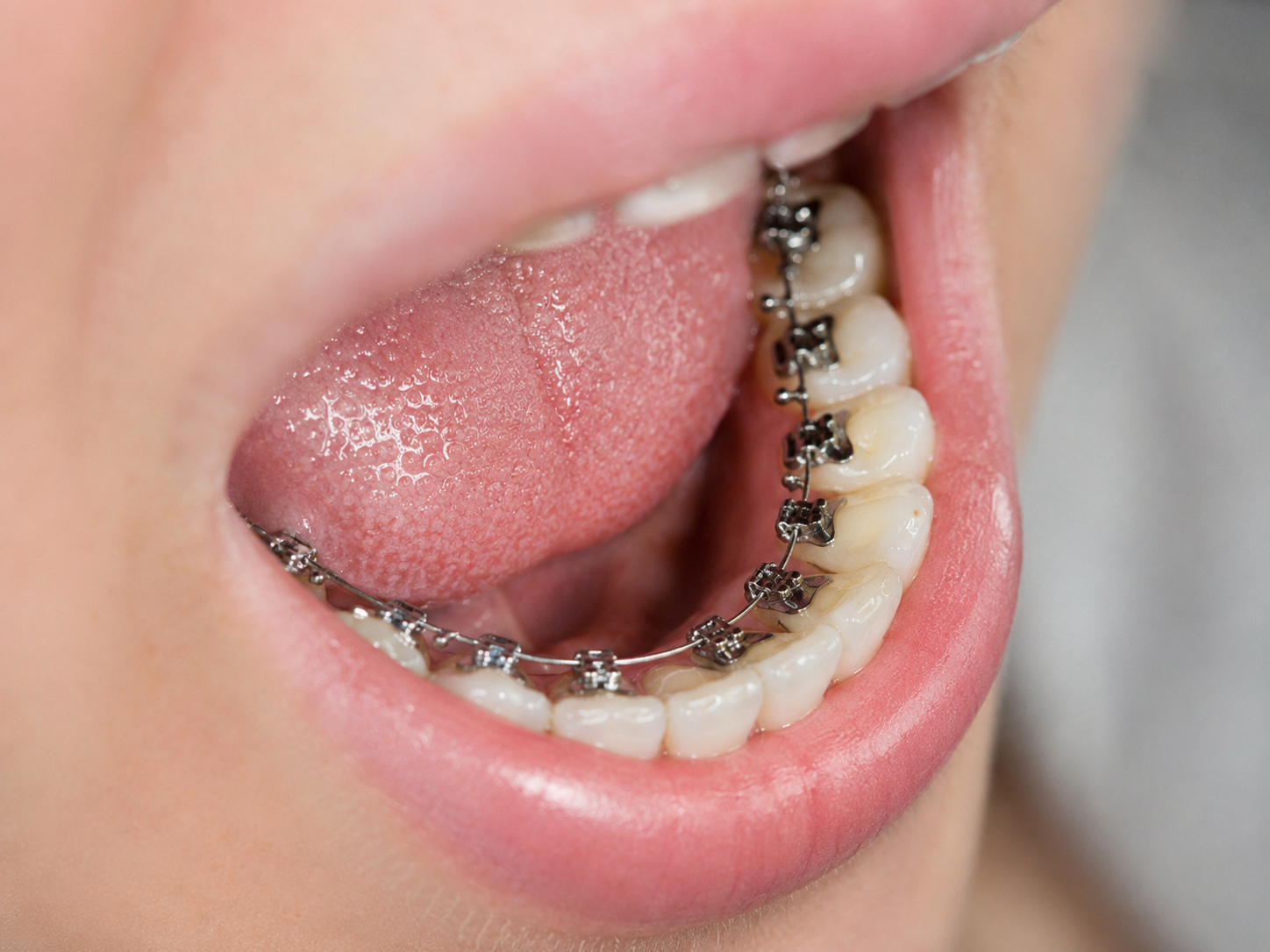 Lingual hidden braces appliance