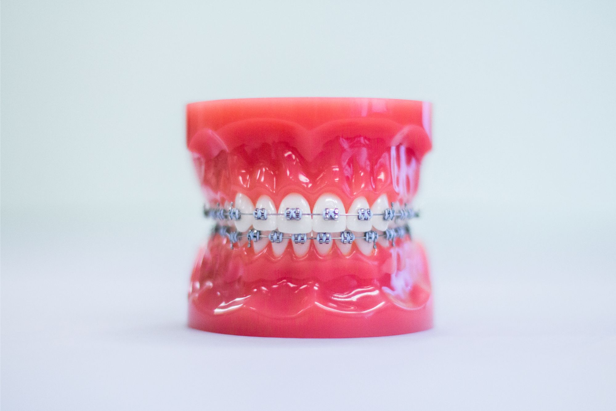 Traditional metal braces