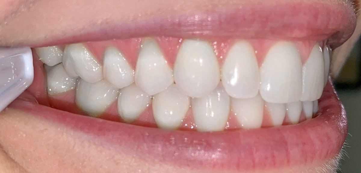 Right side, teeth together