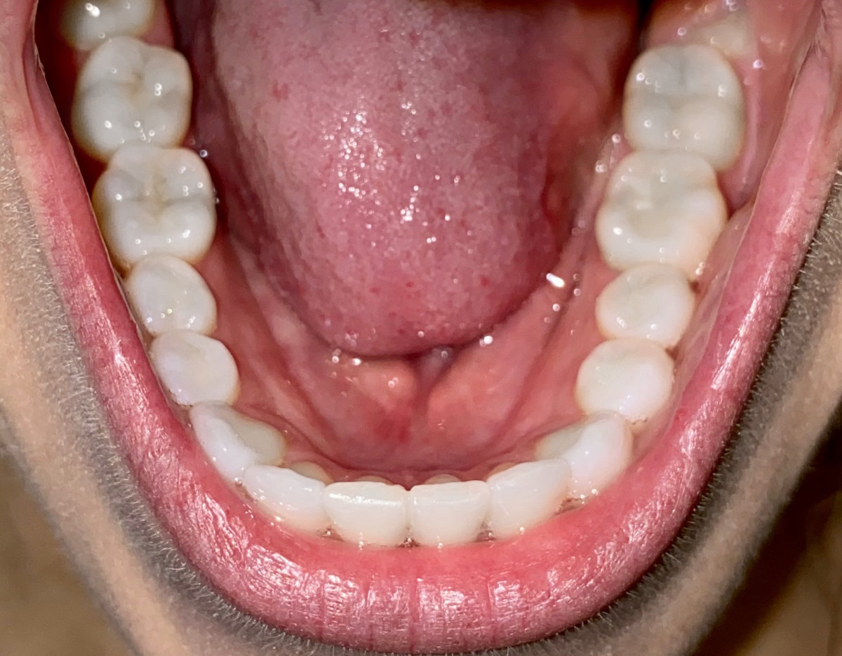 Left side, teeth together