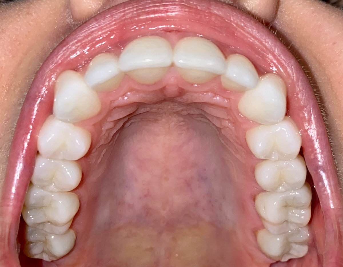 Top teeth (occlusal)